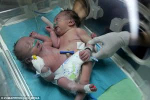 σιαμαία μωρά γεννήθηκαν στη Γάζα