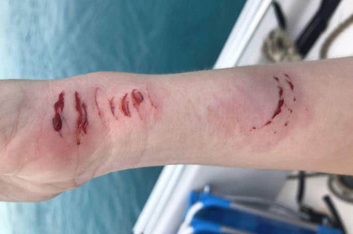 δάγκωμα καρχαρία σε χέρι